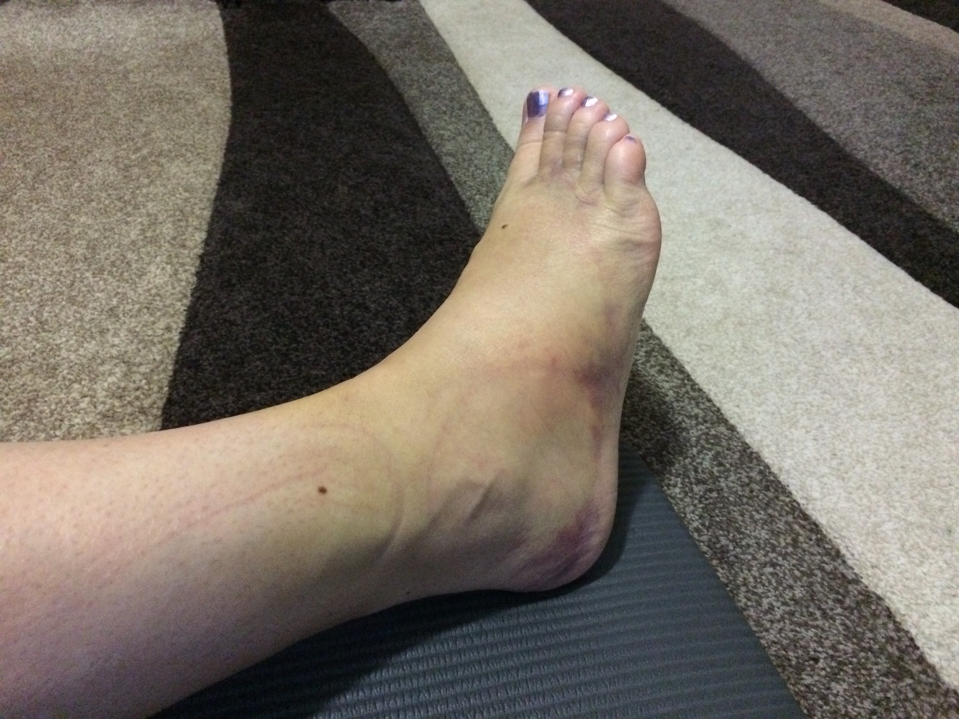 Ankle sprain day 11.